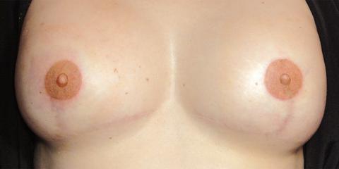 Areola repigmentation permanent cosmetics post-breast cancer mastectomy reconstrutive surgery, after photo