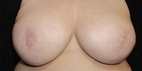 Areola repigmentation permanent cosmetics post-breast cancer mastectomy reconstrutive surgery, before photo
