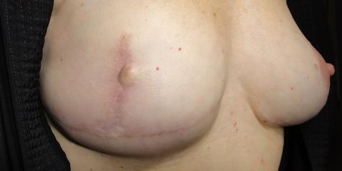 Decorative areola repigmentation permanent cosmetics post-breast cancer mastectomy reconstrutive surgery, before photo