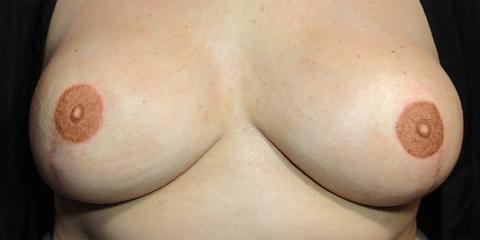 Areola repigmentation permanent cosmetics post-breast cancer mastectomy reconstrutive surgery, after photo