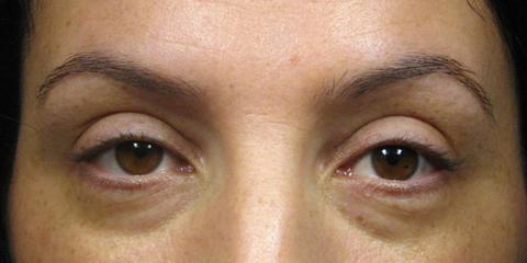 Eyeliner permanent cosmetics, before photo