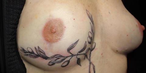 Decorative areola repigmentation permanent cosmetics post-breast cancer mastectomy reconstrutive surgery, after photo
